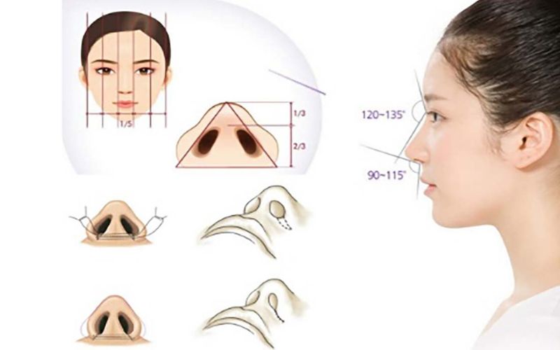 Phương pháp phẫu thuật giúp thu gọn cánh mũi