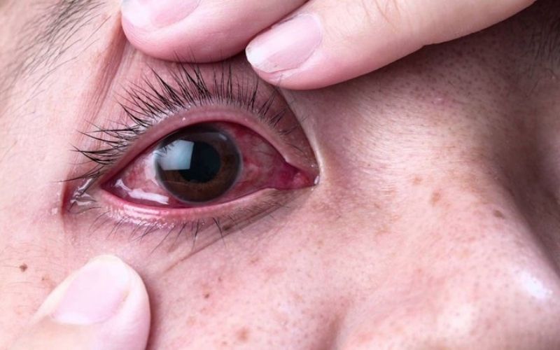 Các bệnh mắt thường gặp do nhiều nguyên nhân khác nhau