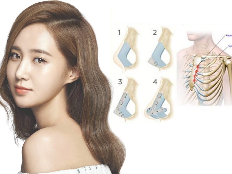 Nâng mũi sụn sườn được áp dụng phức tạp, cần chăm sóc đúng cách