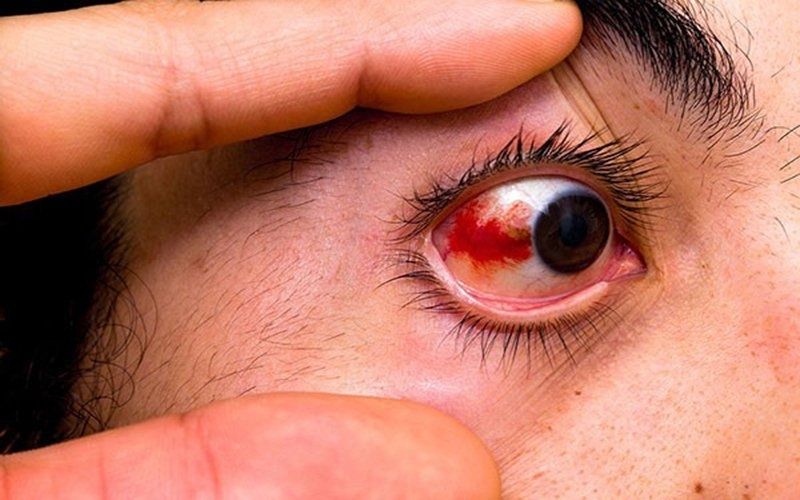 Mắt bị viêm củng mạc có biểu hiện sưng phù, đỏ và đau nhức