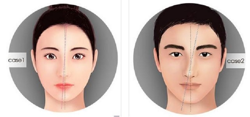Dáng mũi lệch vẹo cũng cần thực hiện cuộn cánh mũi an toàn