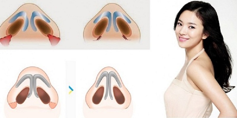 Phương pháp cuộn cánh mũi được thực hiện an toàn, nhẹ nhàng