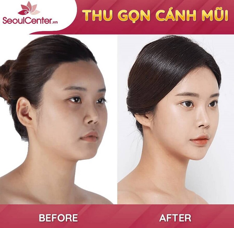 Cận cảnh kết quả cuộn cánh mũi an toàn tại Seoul Center