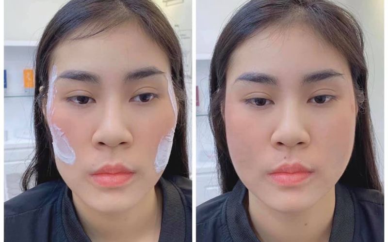 Filler elravie giúp làm đầy khuôn mặt nhanh chóng Filler elravie giúp làm đầy khuôn mặt nhanh chóng