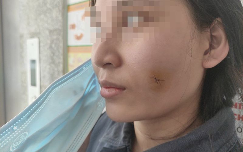 Không nên tự ý tiêm filler elravie tại nhà vì tiềm ẩn nhiều rủi ro Không nên tự ý tiêm filler elravie tại nhà vì tiềm ẩn nhiều rủi ro