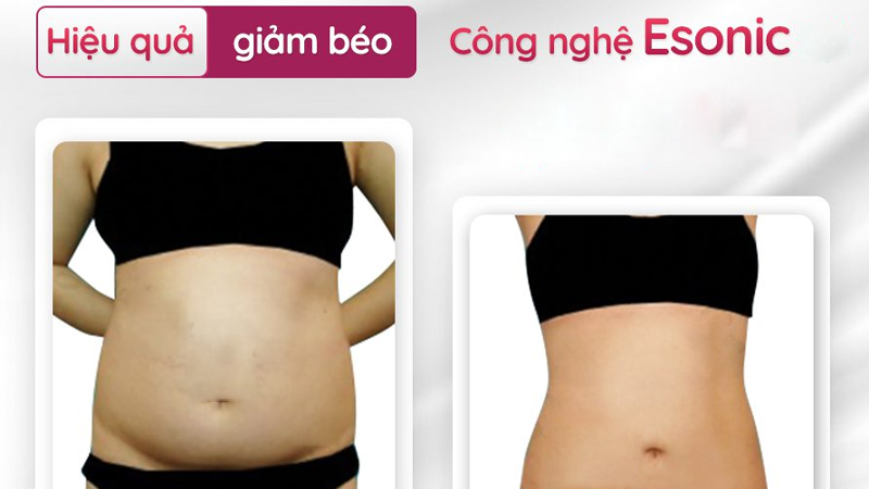 Công nghệ giảm béo E-Sonic giúp vùng eo thon gọn