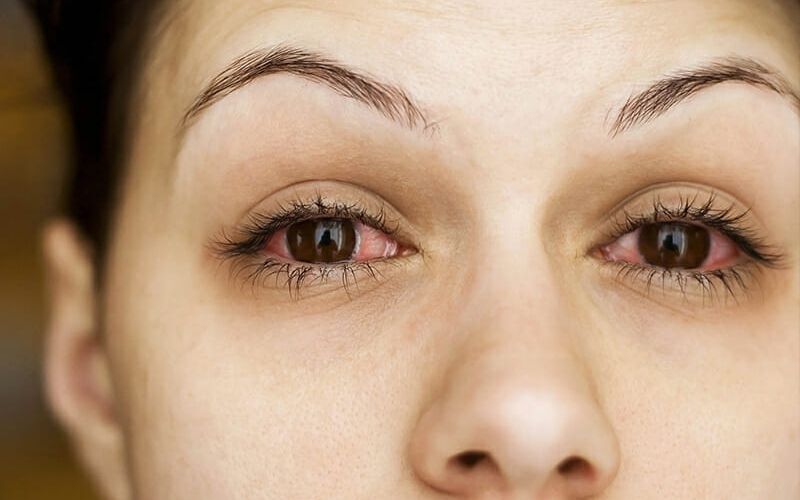 Bệnh về mắt thường gặp và nguyên nhân mắc phải do đâu?
