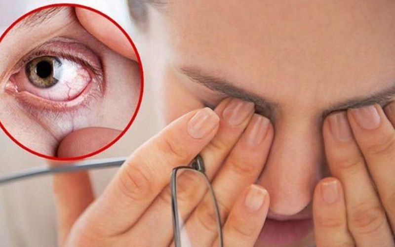 Vi khuẩn tấn công khiến mắt bị viêm