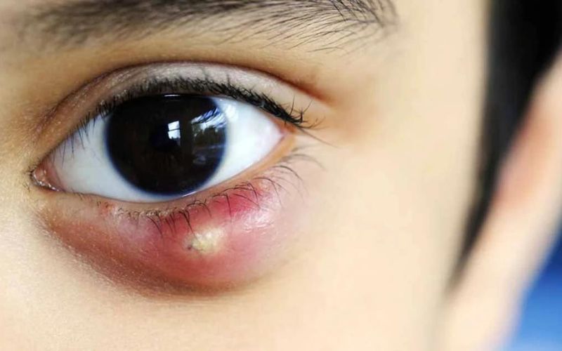 Lẹo mắt có thể làm cho mắt bị đổ ghèn