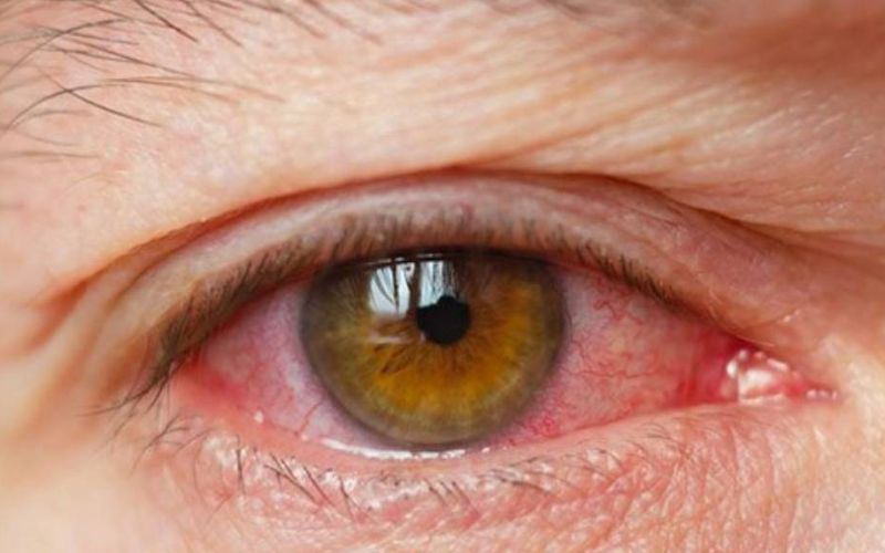 Loét giác mạc là bệnh lý nguy hiểm cần được chữa trị
