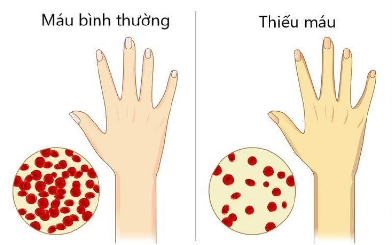Bệnh thiếu máu huyết tán khiến mắt bị vàng