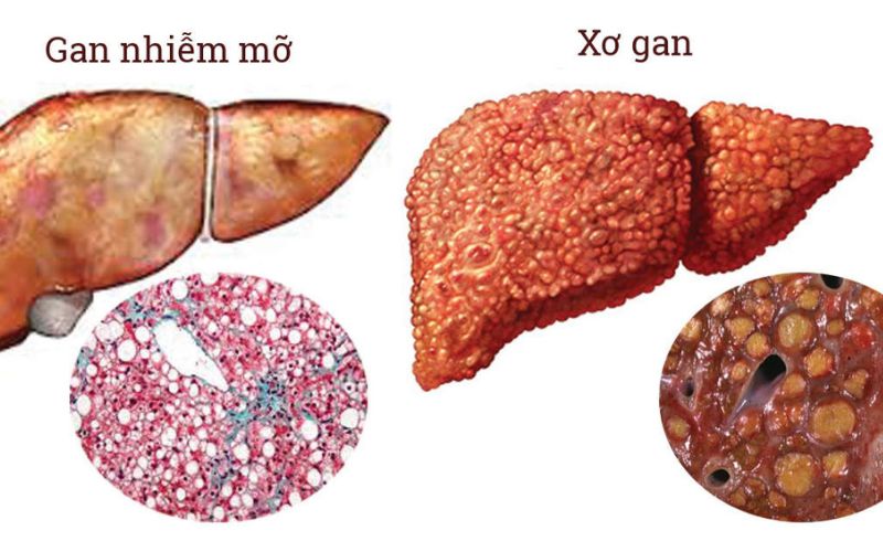 Gan bị hư hại nặng do uống rượu bia