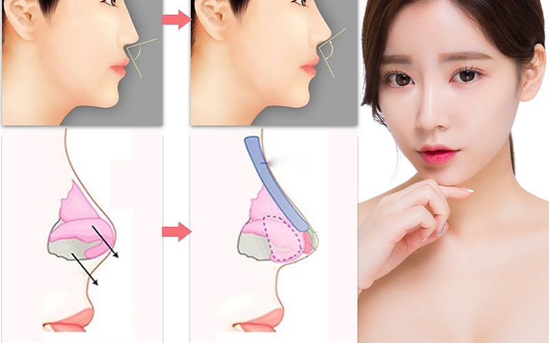 Kỹ thuật nâng mũi bọc sụn an toàn, thực hiện nhanh chóng