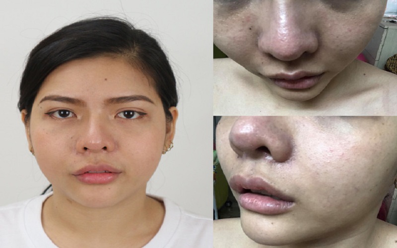 Nâng mũi ở những địa chỉ thẩm mỹ kém uy tín có thể gây ra những biến chứng