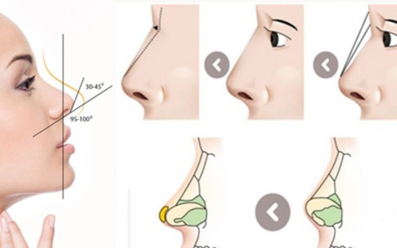 Nâng mũi bọc sụn có sự kết hợp hoàn hảo giữa sụn tự thân với sụn nhân tạo giúp duy trì kết quả làm đẹp lâu dài