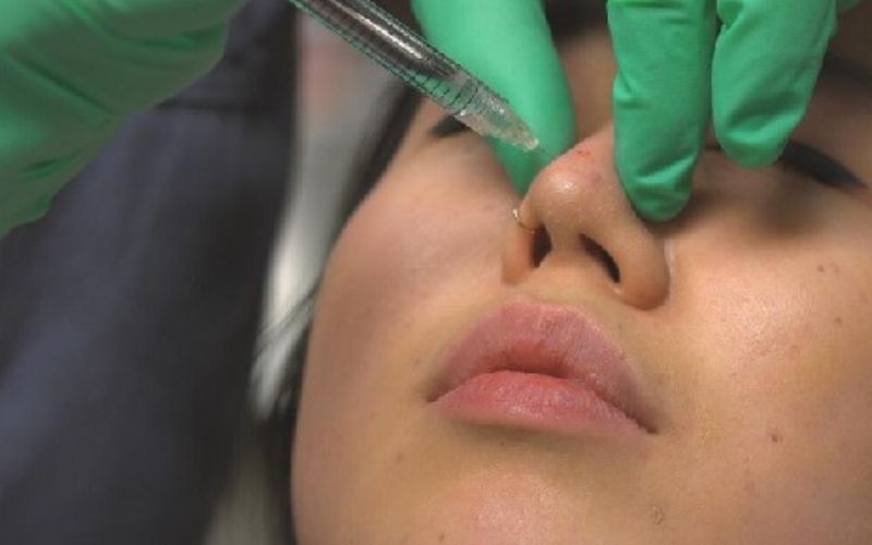Tay nghề bác sĩ là yếu tố ảnh hưởng đến kết quả nâng mũi có lưu giữ được lâu dài hay không
