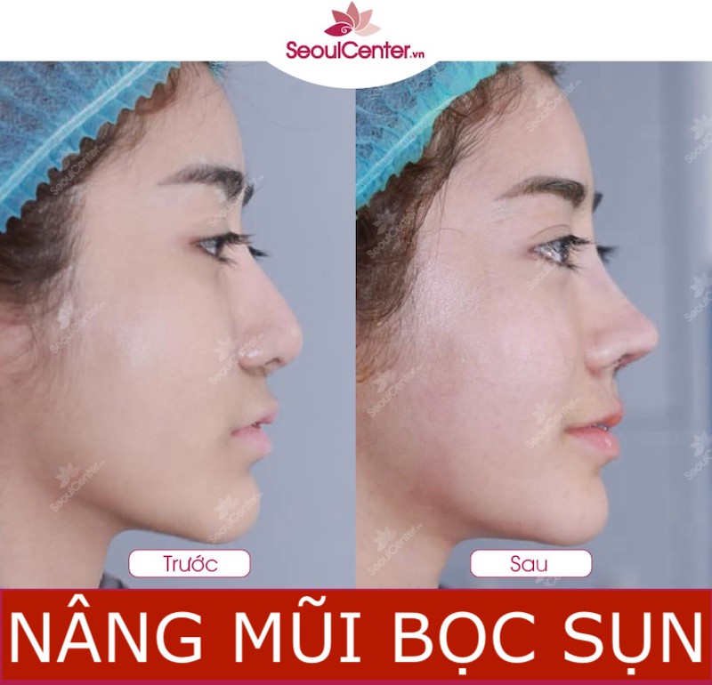 Kết quả nâng mũi bọc sụn mà các bác sĩ ở Seoul Center mang đến cho khách hàng