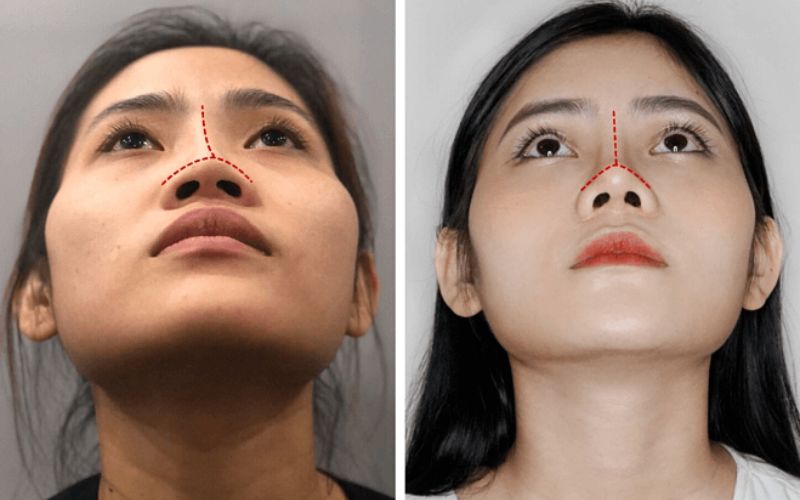 Kết quả chỉnh sửa dáng mũi mới hoàn hảo, không sẹo xấu