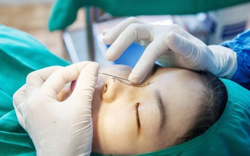 Phẫu thuật nâng mũi bằng chất liệu Pureform tạo ra dáng mũi chắc chắn, đẹp tự nhiên