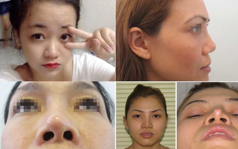 Nâng mũi cấu trúc phù hợp với những ai có nhiều khuyết điểm trên sống mũi