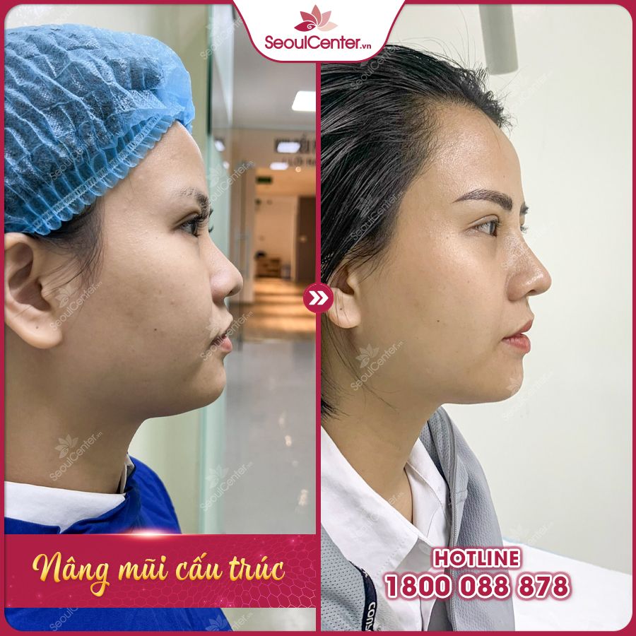 Chiếc mũi hoàn hảo sau khi nâng mang tính thẩm mỹ cao
