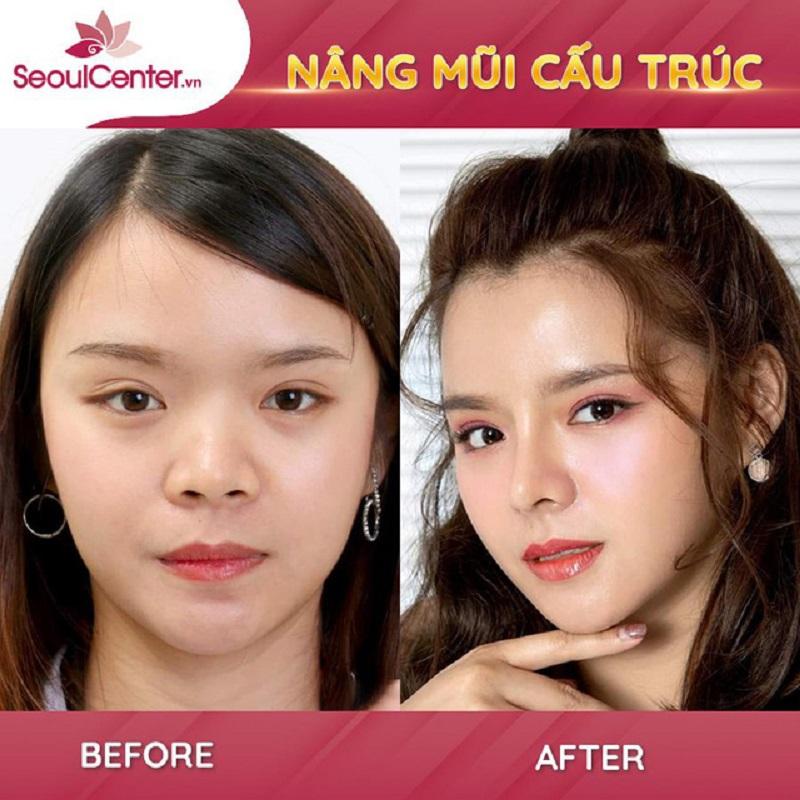 Khách hàng sở hữu chiếc mũi cấu trúc đẹp tự nhiên tại Seoul Center