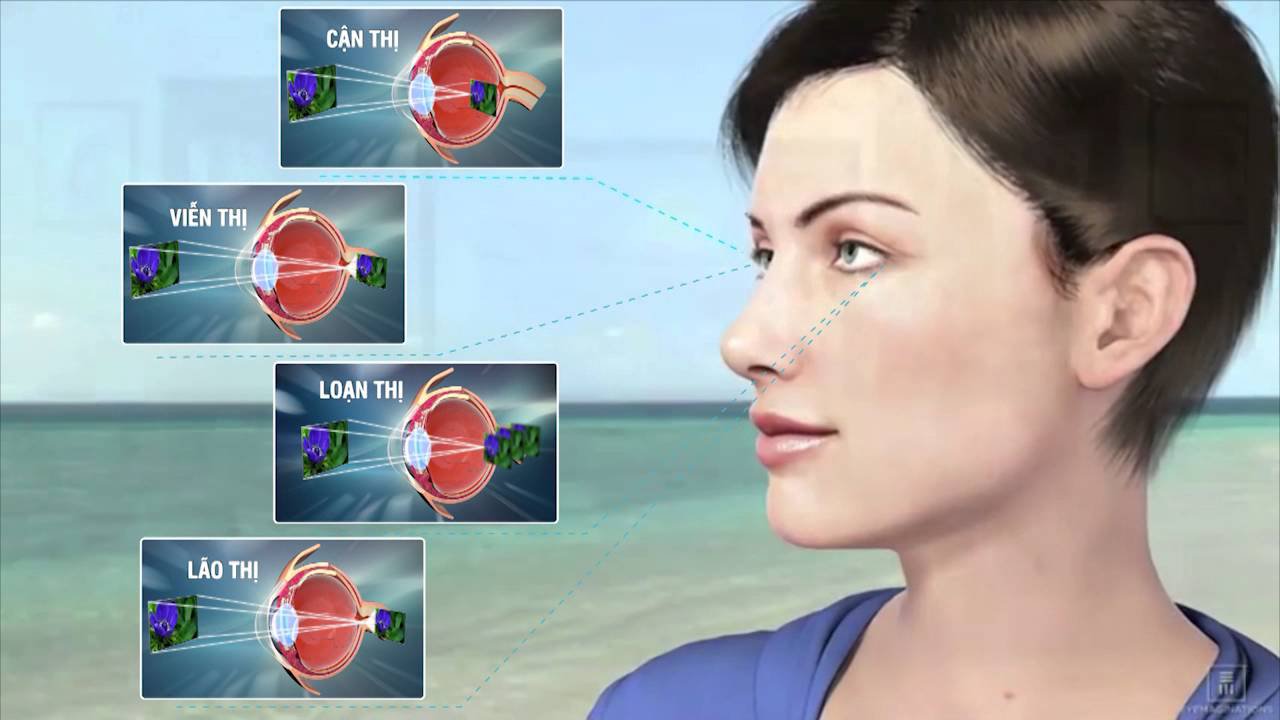 Mắt bị rối loạn điều tiết có thể dẫn đến nhiều tật khúc xạ
