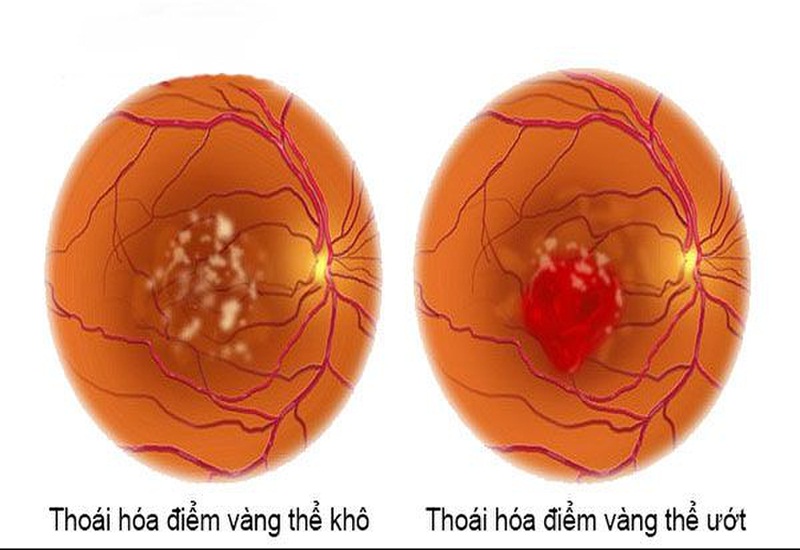 Điểm vàng có thể bị thoái hóa nếu lạm dụng điện thoại quá nhiều