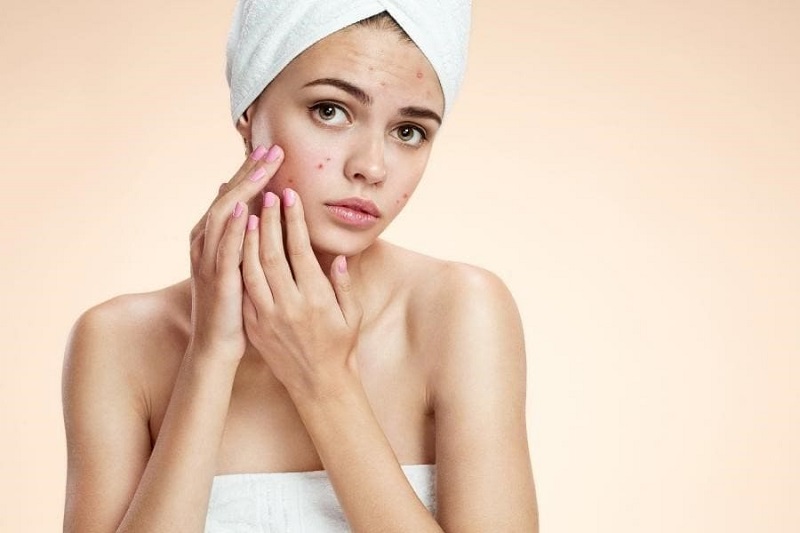 Nổi mụn là điều xảy ra bình thường sau khi tiêm filler vào người Nổi mụn là điều xảy ra bình thường sau khi tiêm filler vào người