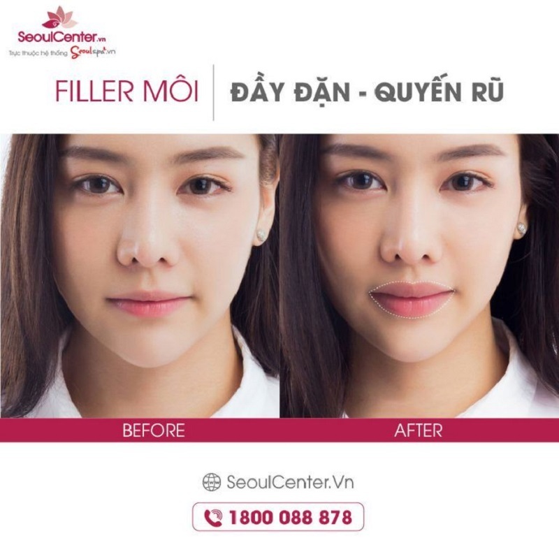 Nên thực hiện tiêm filler môi tại những cơ sở thẩm mỹ uy tín, an toàn Nên thực hiện tiêm filler môi tại những cơ sở thẩm mỹ uy tín, an toàn