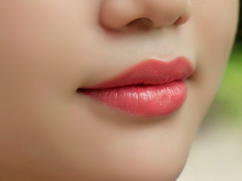 Tiêm filler môi cười mang đến sự tươi trẻ, duyên dáng Tiêm filler môi cười mang đến sự tươi trẻ, duyên dáng