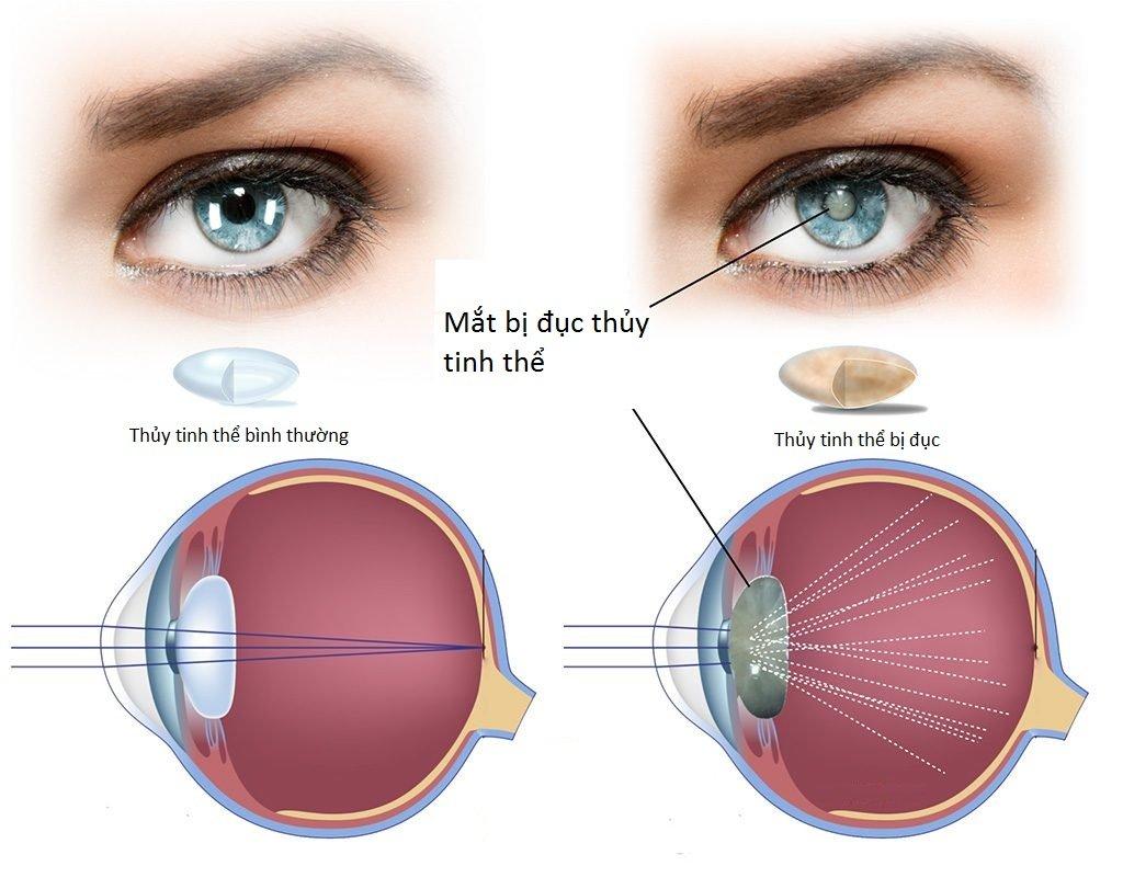 Cận thị thứ phát gây ra do xơ hóa thủy tinh thể