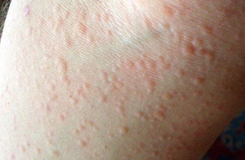 Tác dụng phụ khi sử dụng dầu dừa sai cách