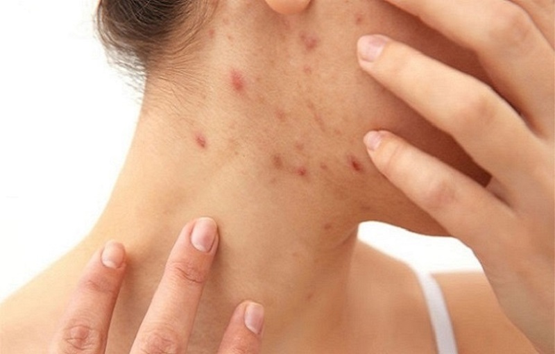 Mụn thâm bị tụ máu và những cách khắc phục hiệu quả
