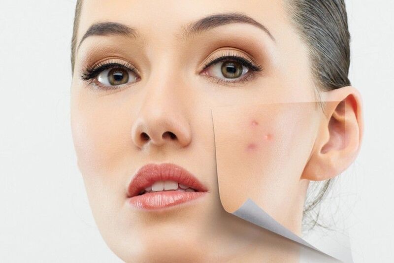 Một số lưu ý trong quá trình cải thiện mụn thâm bị tụ máu