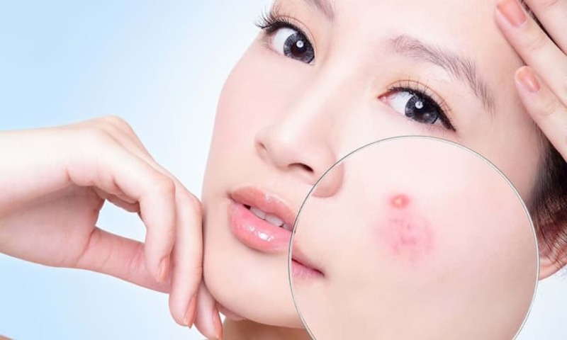 Mụn thâm bị tụ máu thường khiến gương mặt kém tươi tắn