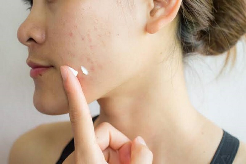 Dùng mỹ phẩm kém chất lượng khiến mụn bị thâm đen và nặng hơn