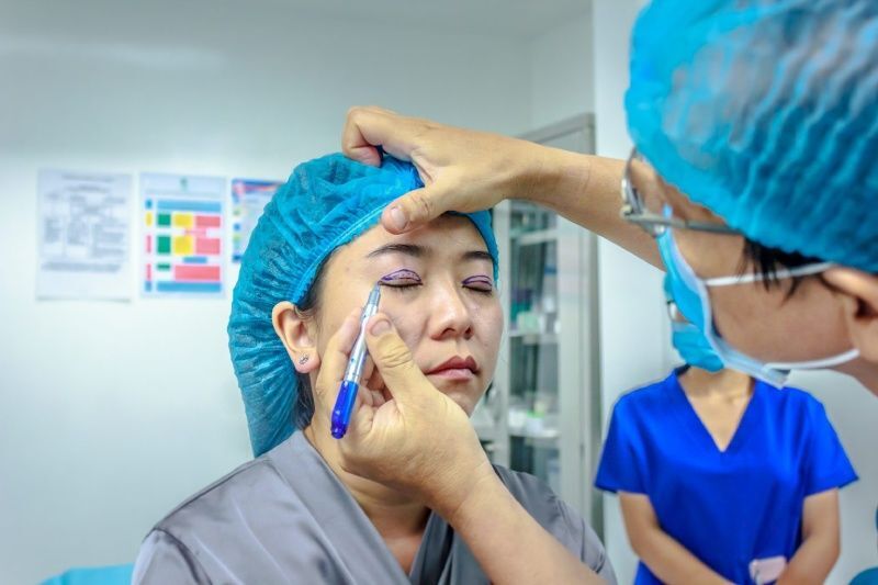 Sau khi nhấn mí có phải cắt chỉ hay không?
