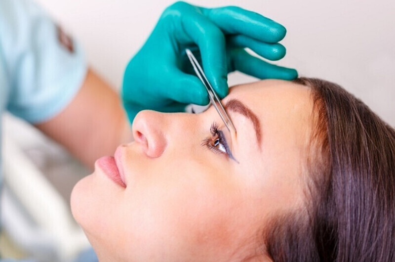 Sau 7 ngày khách hàng sẽ được cắt chỉ theo chỉ định của bác sĩ