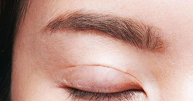 Cần kịp thời xử lý khi chỉ tự tiêu không tan sau khi nhấn mí
