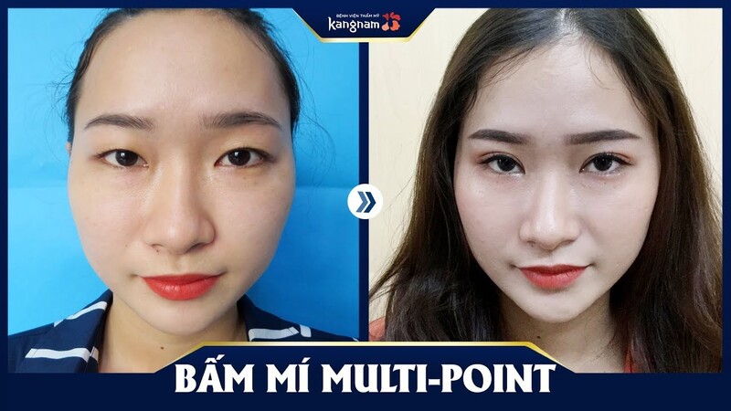 Khách hàng hài lòng với chất lượng nhấn mí tại Kangnam