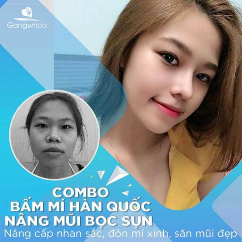 Sở hữu đôi mắt rõ mí nhanh chóng khi thực hiện tại Gangwhoo Hàn Quốc