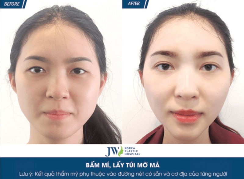 Nhấn mí tại JW có khả năng duy trì lâu dài