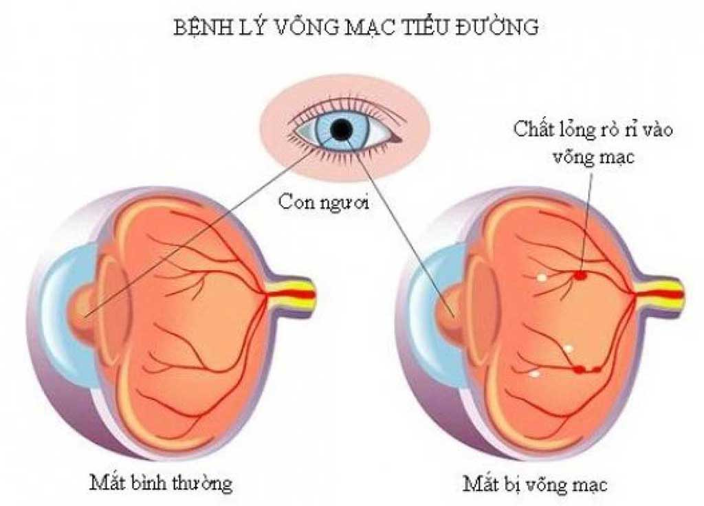 Màng thần kinh thị giác tiểu đường xảy ra do mạch máu bị rối loạn
