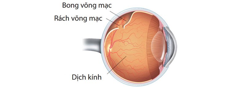 Bong màng nhãn cầu thần kinh không điều trị kịp thời có thể làm giảm thị giác