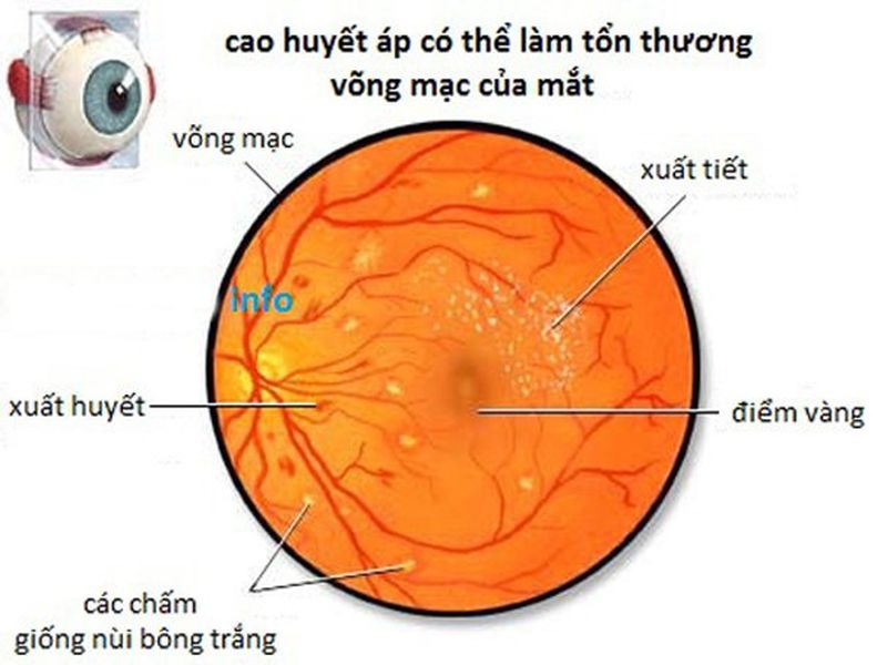 Võng mạc tăng huyết áp có tỷ lệ mắc rất cao