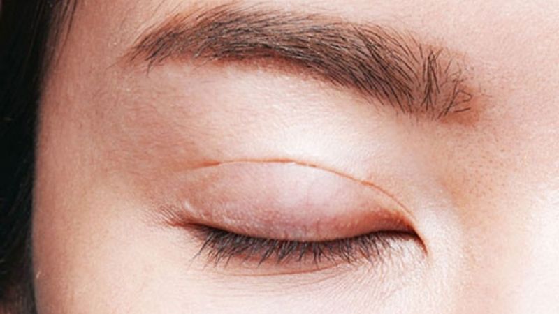 Kiêng ăn trứng vịt lộn sau khi cắt mí để tránh để lại sẹo xấu và vết thương lâu lành