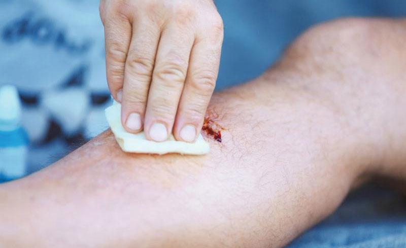 Những lưu ý quan trọng khi chăm sóc vết thương hở sau phẫu thuật