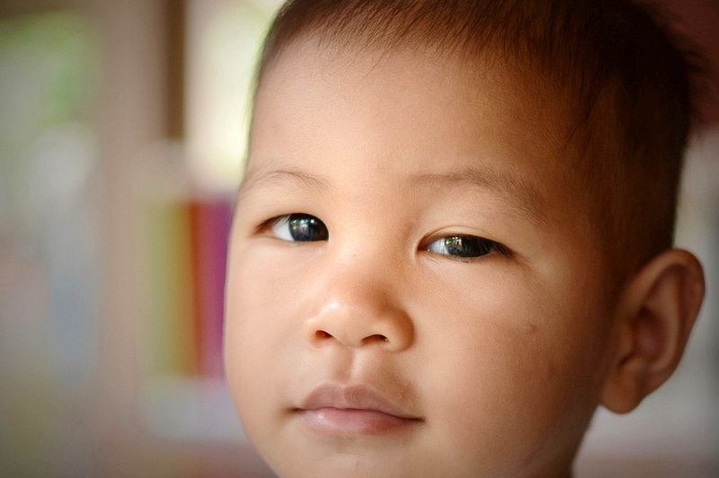 Tình trạng sụp mí ở trẻ có nhiều mức độ khác nhau