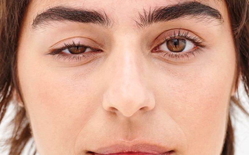 Biểu hiện sụp mí do nhiều nguyên nhân khác nhau